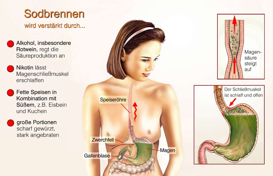 Reflux-Sodbrennen_HEIMisch #74_Beitragsbild im Text